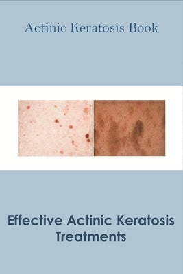 Actinic Keratosis Book_ Effective Actinic Keratosis Treatments: Actinic Keratosis Disease Book by Dorl, Rodrigo