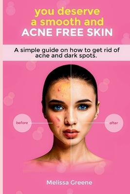 you deserve a smooth and acne free skin: a simple guide on how to get rid of acne by Greene, Melissa