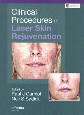 Clinical Procedures in Laser Skin Rejuvenation by Carniol, Paul