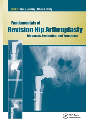 Fundamentals of Revision Hip Arthroplasty: Diagnosis, Evaluation, and Treatment by Jacofsky, David