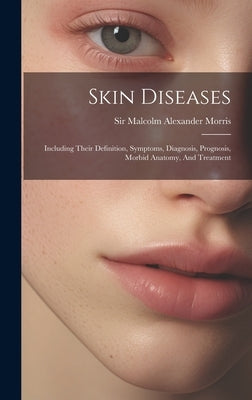 Skin Diseases: Including Their Definition, Symptoms, Diagnosis, Prognosis, Morbid Anatomy, And Treatment by Sir Malcolm Alexander Morris