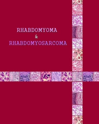 Rhabdomyoma & Rhabdomyosarcoma by Matevosyan, Naira Roland