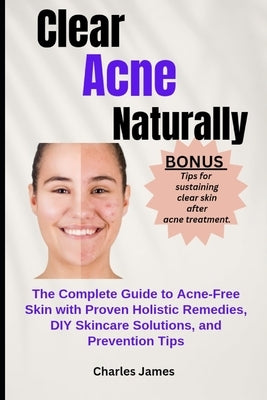 Clear Acne Naturally: The Complete Guide to Acne-Free Skin with Proven Holistic Remedies, DIY Skincare Solutions, and Prevention Tips by James, Charles