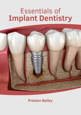 Essentials of Implant Dentistry by Bailey, Preston