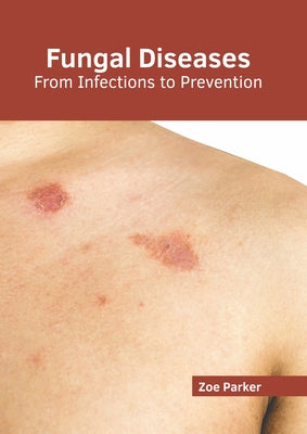 Fungal Diseases: From Infections to Prevention by Parker, Zoe