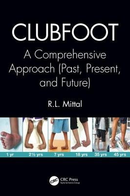 Clubfoot: A Comprehensive Approach (Past, Present, and Future) by Mittal, R. L.