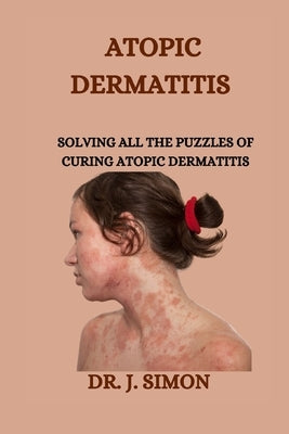 Atopic Dermatitis: Solving All the Puzzles of Curing Atopic Dermatitis by Simon, J.
