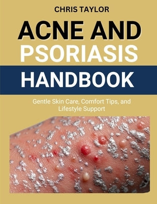 Acne and Psoriasis Handbook: Gentle Skin Care, Comfort Tips, and Lifestyle Support by Taylor, Chris