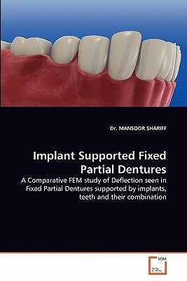 Implant Supported Fixed Partial Dentures by Shariff, Mansoor