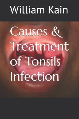 Causes & Treatment of Tonsils Infection by Kain, William