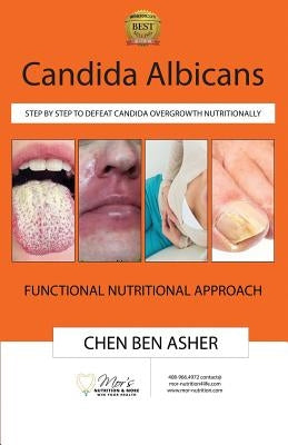 Candida Albicans: Step by Step to Defeat Candida Overgrowth Nutritionally by Ben Asher, Chen