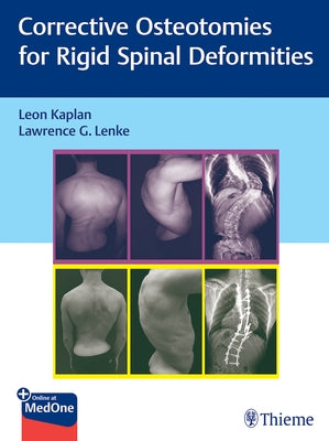 Corrective Osteotomies for Rigid Spinal Deformities by Kaplan, Leon
