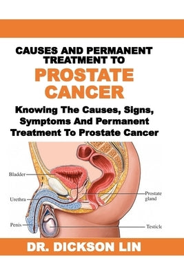 Causes and Permanent Treatment to Prostate Cancer: Knowing The Causes, Signs, Symptoms And Permanent Treatment To Prostate Cancer by Lin, Dickson
