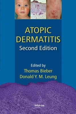 Atopic Dermatitis by Bieber, Thomas