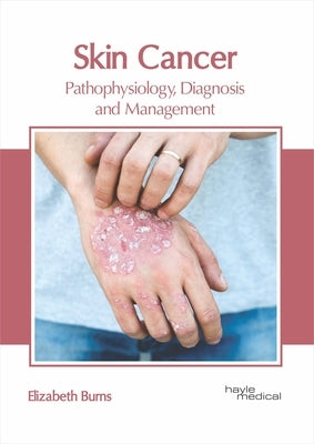 Skin Cancer: Pathophysiology, Diagnosis and Management by Burns, Elizabeth