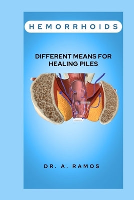 Hemorrhoids: Different Means for Healing Piles by Ramos, A.