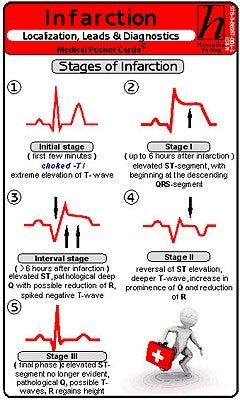 Infarction Localization, Leads & Diagnostics by Hawelka Publishing