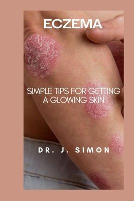 Eczema: Simple Tips for Getting a Glowing Skin by Simon, J.