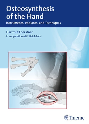 Osteosynthesis of the Hand: Instruments, Implants, and Techniques by Förstner, Hartmut