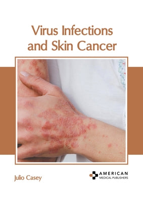 Virus Infections and Skin Cancer by Casey, Julio