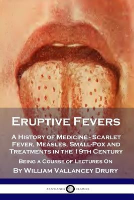 Eruptive Fevers: A History of Medicine - Scarlet Fever, Measles, Small-Pox and Treatments in the 19th Century - Being a Course of Lectu by Drury, William Vallancey
