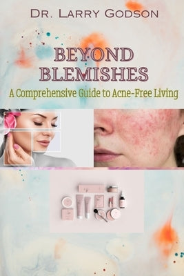 Beyond Blemishes: A Comprehensive Guide to Acne-Free Living/ Skincare Bible for Radiant Skin by Godson, Larry
