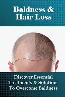 Baldness & Hair Loss: Discover Essential Treatments & Solutions To Overcome Baldness: How To Prevent Hair Loss For Guys by Cassandra, Bret