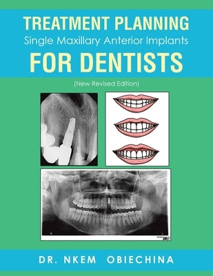 Treatment Planning Single Maxillary Anterior Implants for Dentists by Obiechina, Nkem