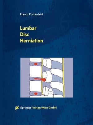 Lumbar Disc Herniation by Postacchini, Franco