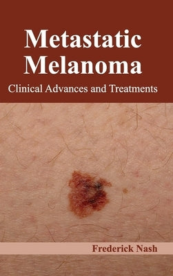 Metastatic Melanoma: Clinical Advances and Treatments by Nash, Frederick
