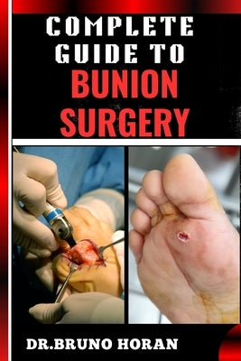 Complete Guide to Bunion Surgery: Essential Handbook For Expert Techniques, Recovery Tips, And Pain Management For Optimal Foot Health by Horan, Bruno