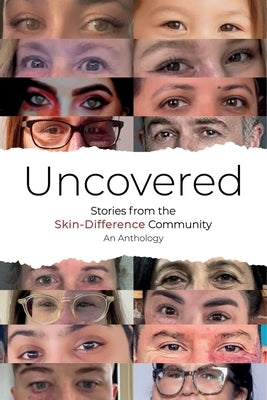 Uncovered: Stories from the Skin-Difference Community by Prangner, Hanna