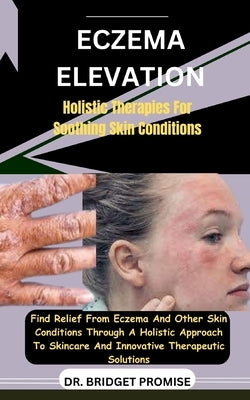 Eczema Elevation: Holistic Therapies For Soothing Skin Conditions: Find Relief From Eczema And Other Skin Conditions Through A Holistic by Promise, Bridget