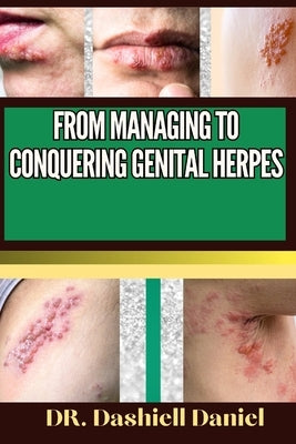 From Managing to Conquering Genital Herps: Expert Guide To Understanding the Causes, Recognizing Symptoms, Prevention and Embracing Effective Treatmen by Daniel, Dashiell