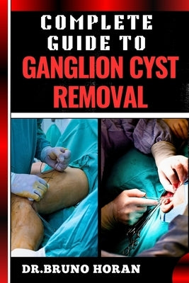 Complete Guide to Ganglion Cyst Removal: Comprehensive Handbook To Expert Techniques, Home Remedies, And Post Surgery Care For Pain Relief And Healing by Horan, Bruno