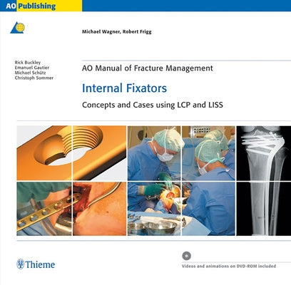 Ao Manual of Fracture Management: Internal Fixators: Concepts and Cases Using Lcp/Liss by Wagner, Michael
