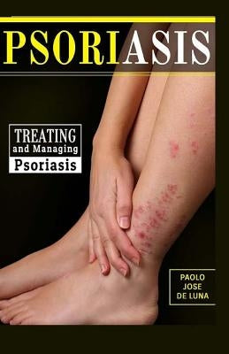 Psoriasis: Treating and Managing Psoriasis by Jose De Luna, Paolo