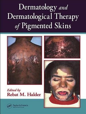 Dermatology and Dermatological Therapy of Pigmented Skins by Halder, Rebat