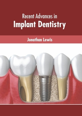 Recent Advances in Implant Dentistry by Lewis, Jonathan