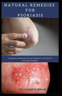Natural Remedies for Psoriasis: A Simple and Natural Proven Solution to Get Rid of Your Skin Problem: Dermatitis, Eczema, Psoriasis & Rosacea and Othe by David, Elizabeth