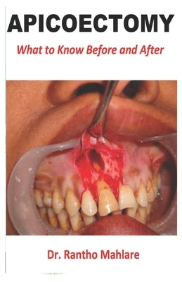 Apicoectomy: What to Know Before and After by Mahlare, Rantho