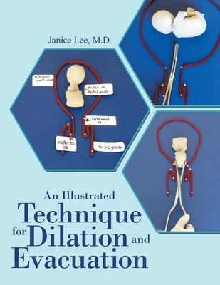 An Illustrated Technique for Dilation and Evacuation by Lee, Janice