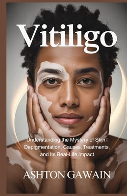 Vitiligo: Understanding the Mystery of Skin Depigmentation, Causes, Treatments, and Its Real-Life Impact by Gawain, Ashton