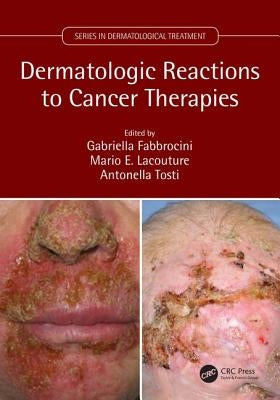Dermatologic Reactions to Cancer Therapies by Fabbrocini, Gabriella