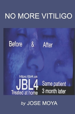 No More Vitiligo by Moya, Jose