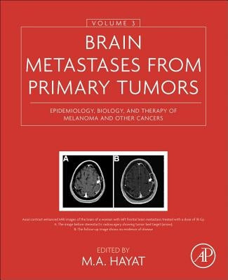 Brain Metastases from Primary Tumors, Volume 3: Epidemiology, Biology, and Therapy of Melanoma and Other Cancers by Hayat, M. A.
