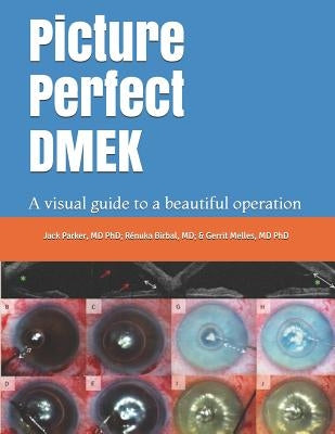 Picture Perfect Dmek: A Visual Guide to a Beautiful Operation by Birbal, Renuka