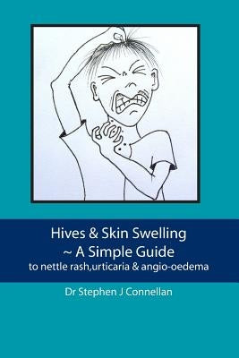 Hives & Skin Swelling A Simple Guide: to nettle rash, urticaria & angio-oedema by Connellan, Stephen J.
