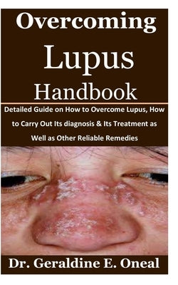 Overcoming Lupus Handbook: Detailed Guide on How to Overcome Lupus, How to Carry Out Its diagnosis & Its Treatment as Well as Other Reliable Reme by Oneal, Geraldine E.
