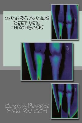 Understanding Deep Vein Thrombosis by Barros, Claudia
